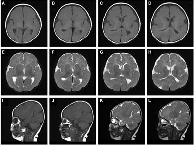 Lissencephaly caused by a de novo mutation in tubulin TUBA1A: a case report and literature review